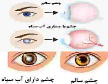 عمل آب سیاه چشم